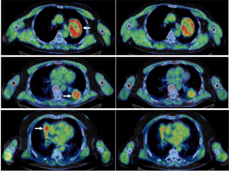 Pre and post atovoquone treatment lung scans in three patients, pre on the left, post on the right. The reduced amount of high intensity red references greater oxygen and thus a reduction in hypoxic environments. Pre and post atovoquone treatment lung scans in three patients, pre on the left, post on the right. The reduced amount of high intensity red references greater oxygen and thus a reduction in hypoxic environments.